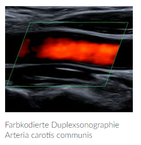 Das Bild zeigt eine farbkodierte Duplexsonographie 