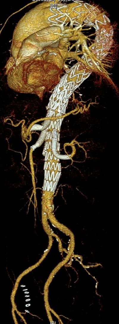 4-fach-gebranchter thorakoabdomineller Aortenstentgraft