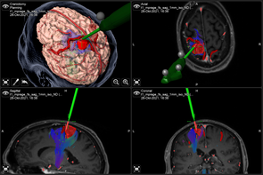 Das Bild zeigt den Einsatz von Fibertracking im neurochirurgischen OP.
