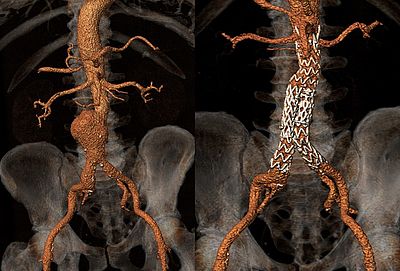 Bauchaortenaneurysma vor und nach endovaskulärer Therapie 