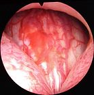Das Bild zeigt die Verengung der Harnröhre durch die Prostata