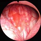 Das Bild zeigt die Verengung der Harnröhre durch die Prostata