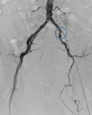 Das Bild zeigt die angiografische Aufnahme zu Beginn der Behandlung einer peripheren Arteriellen Verschlusskrankheit (pAVK).