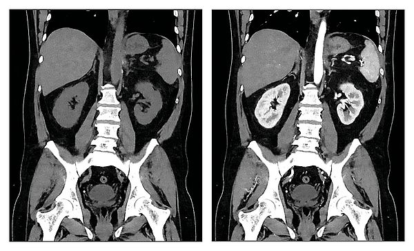 Das Bild zeigt zwei CT-Scans des Bauchraums: einmal ohne (links) und einmal mit (rechts) Kontrastmittel.