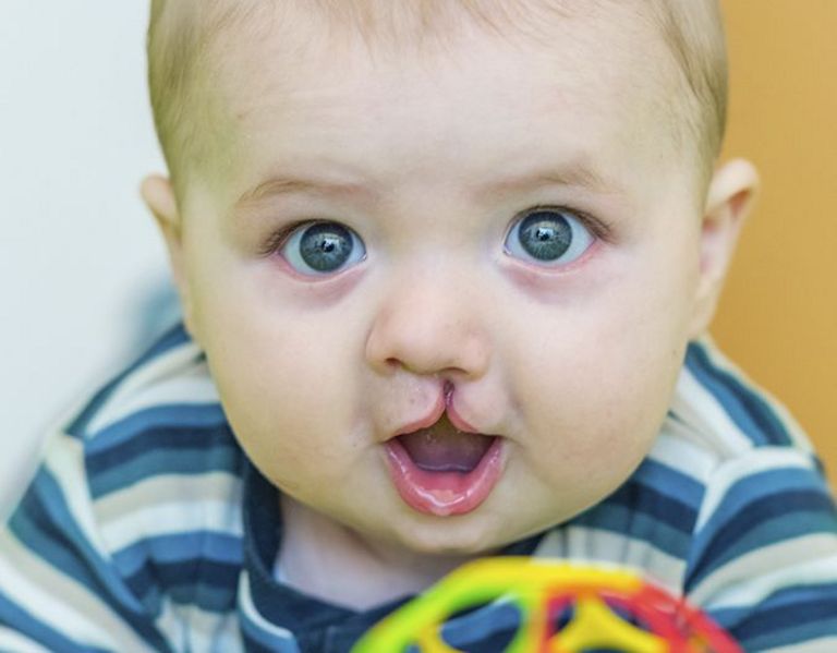 Das Bild zeigt ein Baby mit einer Lippen-Kiefer-Gaumenspalte