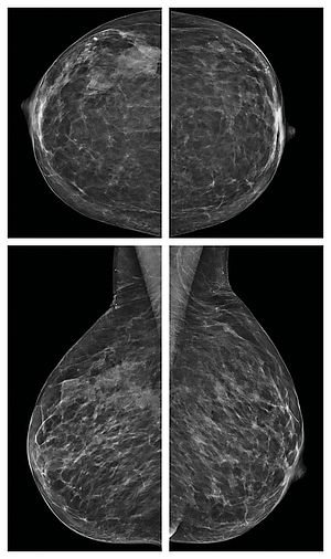 Die Bilder zeigen Mammografien der linken und der rechten Brust.