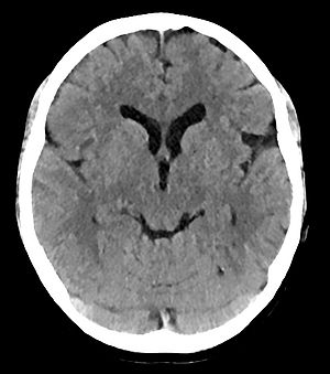 Das Bild zeigt ein CT-Bild eines Kopfes