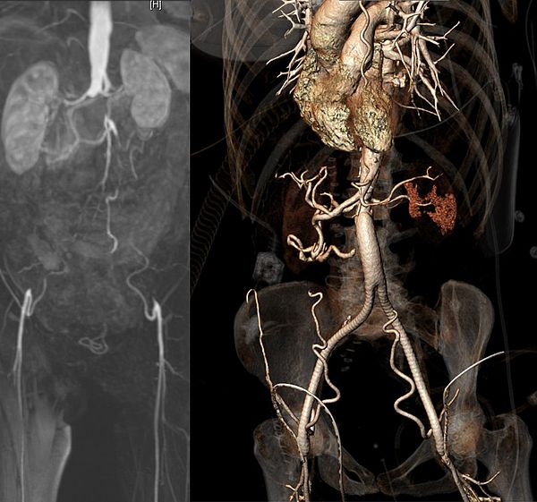 Infrarenaler Aortenverschluss vor und nach operativer Therapie (Y-Prothesenimplantation)